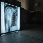 A medical X-ray shows the complex surgical repairs inside a MotoGP rider's shoulder.
